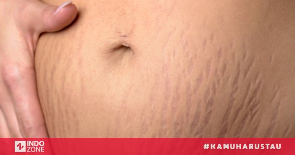 6 Cara Menghilangkan Stretch Mark Setelah Melahirkan Dengan Bahan Alami Indozone Id