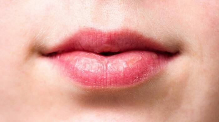 Ilustrasi bibir pecah pecah (helpyourskin.co.uk) penyebab bibir kering pecah pecah