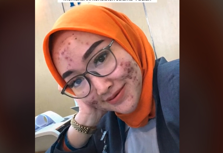 Seorang teller bank wajahnya berjerawat viral viral, video viral, teller bank berjerawat