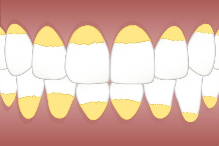 Ilustrasi gigi kuning. (Pixabay/kreatikar) Ilustrasi gigi kuning