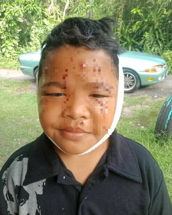 Muhammad Adam Harith Husyazi yang mengalami luka parah karena dicakar kucing. (Photo/mStar) dicakar kucing