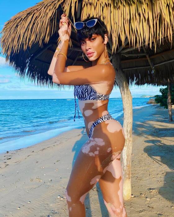 Winnie Harlow. (Photo/Instagram) Perempuan Ini Mewakili Kecantikan Yang Beragam